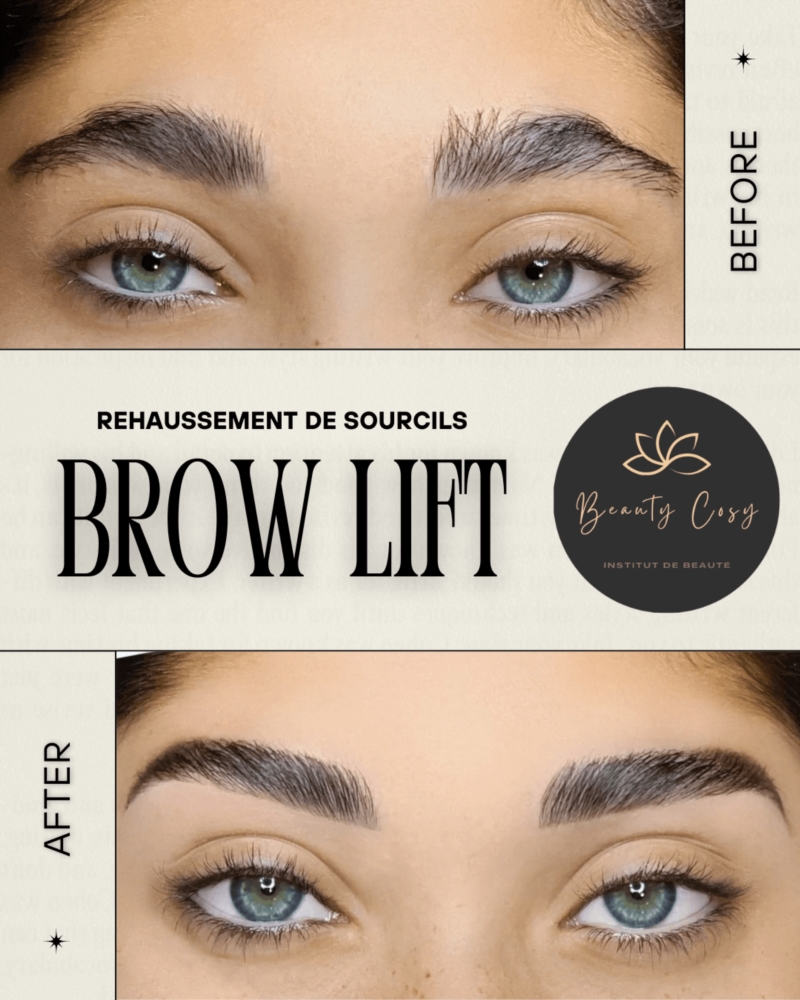 BROW LIFT
