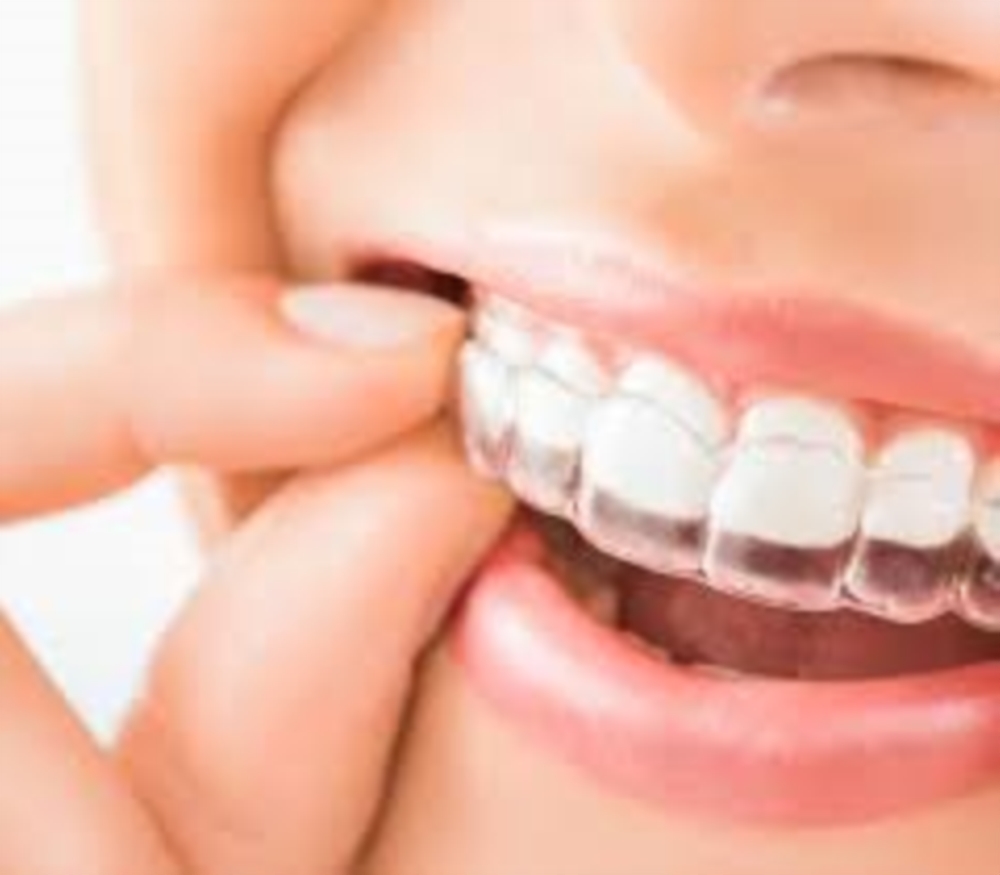 Orthodontie invisible