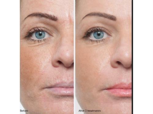 micro-needling