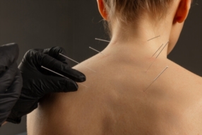 Dry Needling