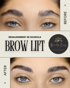 BROW LIFT