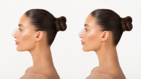 La Rhinoplastie Médicale : Une Alternative Non Chirurgicale